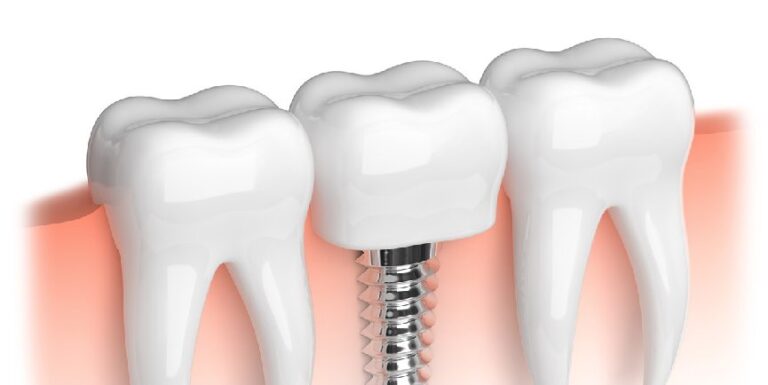 Illustration of a dental implant