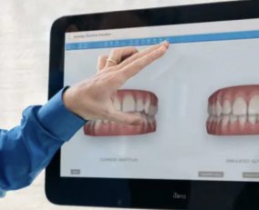 Invisalign dentist consultation using computer screen