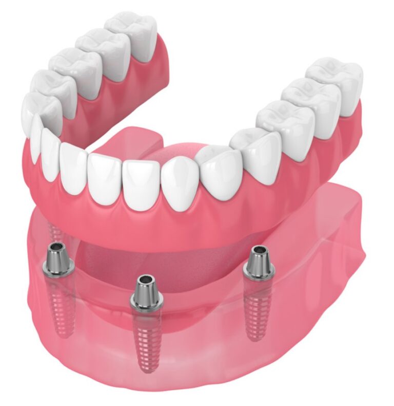 Implanted dentures illustration