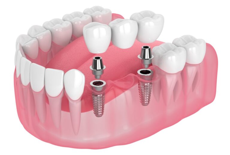 Multiple dental implants illustration