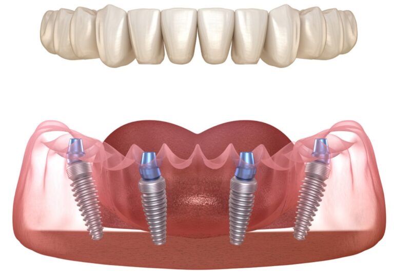 Same day implants illustration