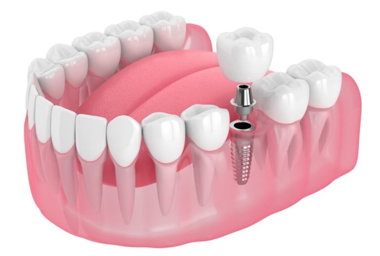 Single dental implant illustration