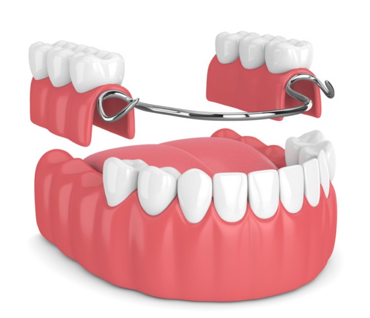 dentures