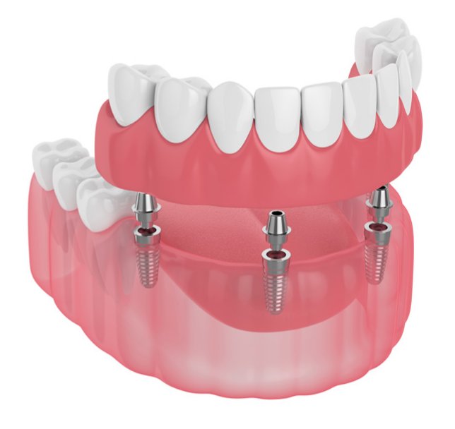 dentures