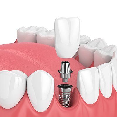 Dental implants illiustration