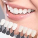 dental veneers